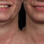 Face lift & Neck lift Before and After Photos in Newburgh, NY, Patient 19365