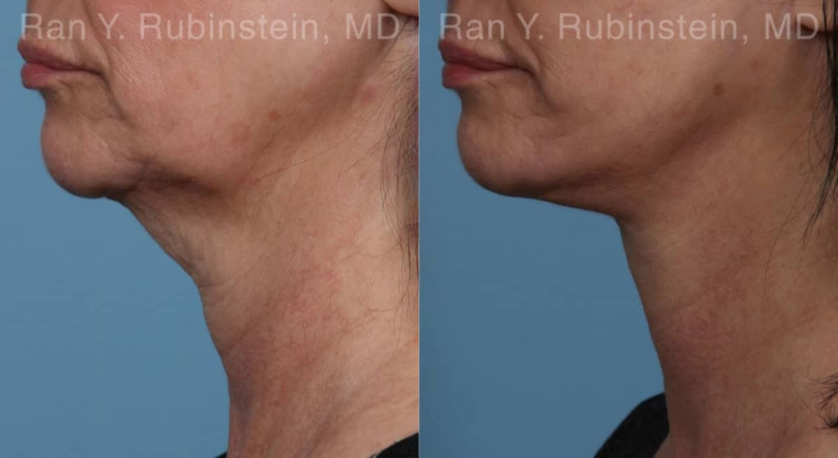 Face lift & Neck lift Before and After Photos in Newburgh, NY, Patient 19365