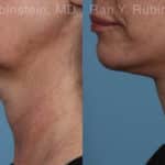 Face lift & Neck lift Before and After Photos in Newburgh, NY, Patient 19365