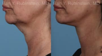 Face lift & Neck lift Before and After Photos in Newburgh, NY, Patient 19365