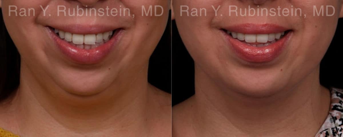 Chin Augmentation Before and After Photos in Newburgh, NY, Patient 19433