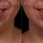 Chin Augmentation Before and After Photos in Newburgh, NY, Patient 19433