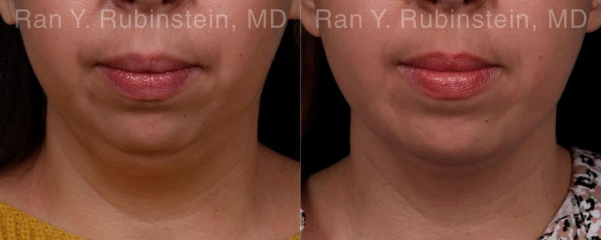 Chin Augmentation Before and After Photos in Newburgh, NY, Patient 19433