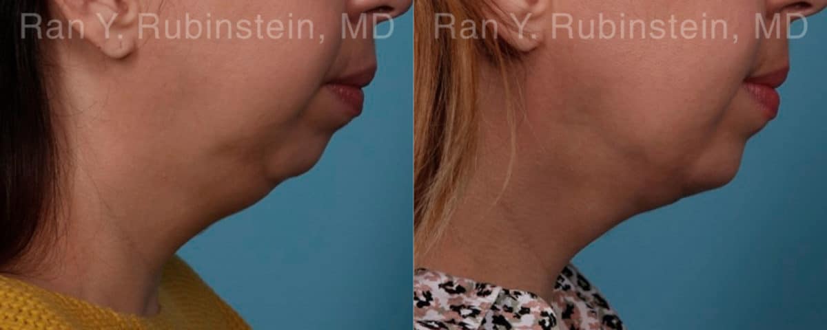 Chin Augmentation Before and After Photos in Newburgh, NY, Patient 19433