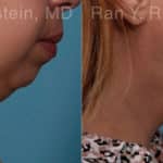 Chin Augmentation Before and After Photos in Newburgh, NY, Patient 19433