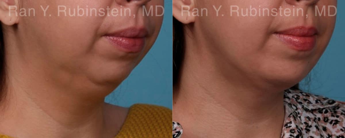 Chin Augmentation Before and After Photos in Newburgh, NY, Patient 19433