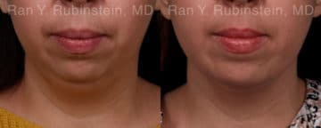 Chin Augmentation Before and After Photos in Newburgh, NY, Patient 19433