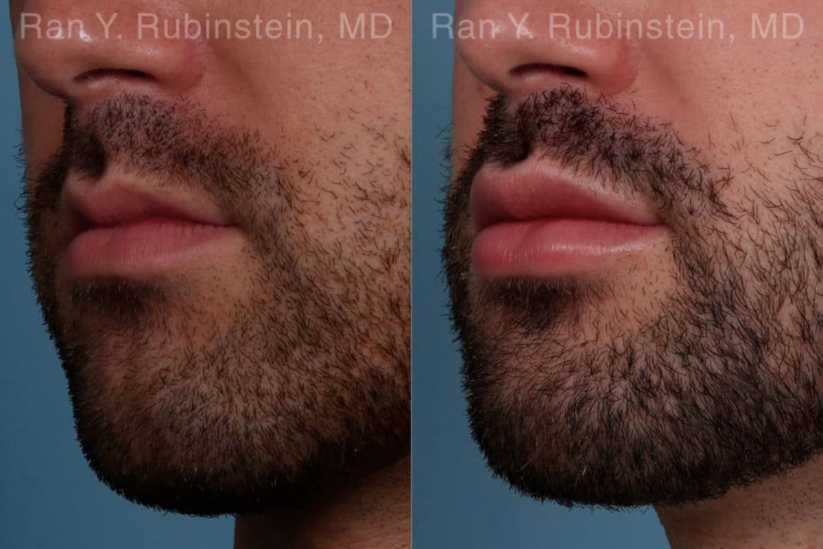 Lip Fillers Before and After Photos in Newburgh, NY, Patient 19484