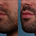 Lip Fillers Before and After Photos in Newburgh, NY, Patient 19484