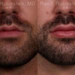 Lip Fillers Before and After Photos in Newburgh, NY, Patient 19484