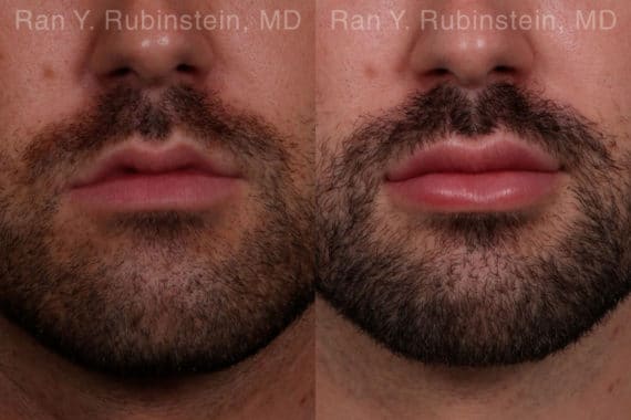 Lip Fillers Before and After Photos in Newburgh, NY, Patient 19484