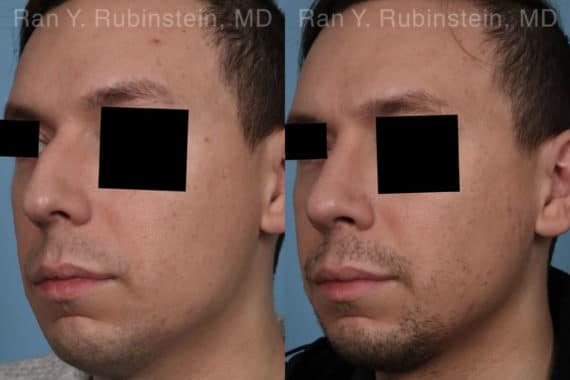 Rhinoplasty Before and After Photos in Newburgh, NY, Patient 19601