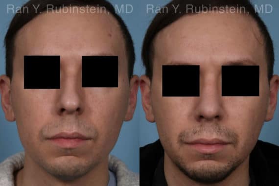 Rhinoplasty Before and After Photos in Newburgh, NY, Patient 19601