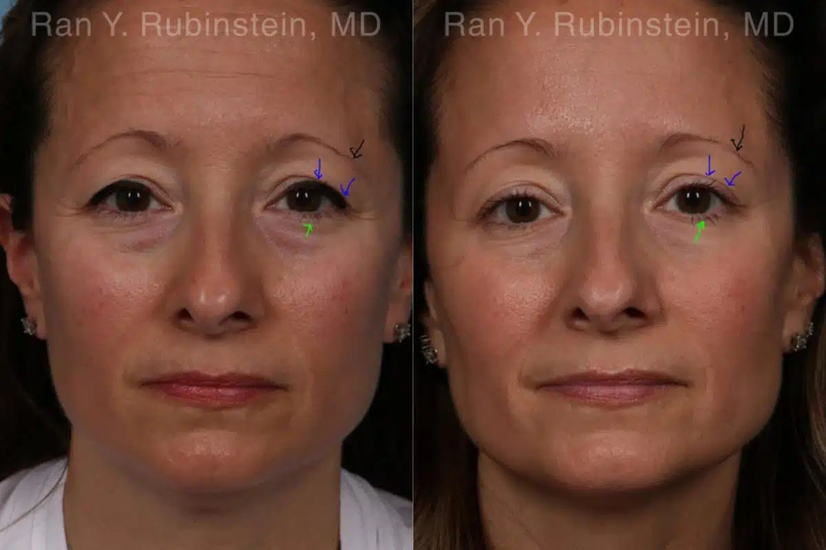 Botox Before and After Photos in Newburgh, NY, Patient 19722