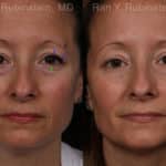 Botox Before and After Photos in Newburgh, NY, Patient 19722