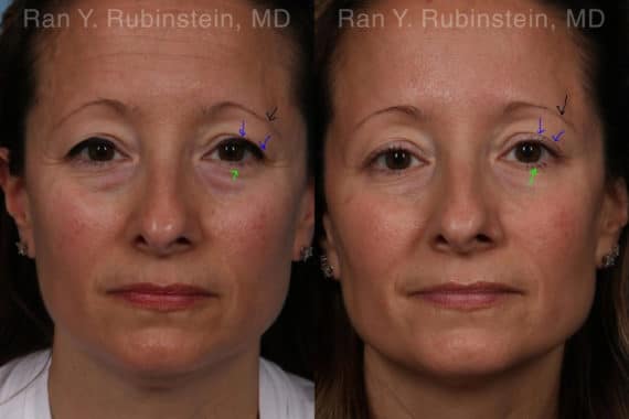 Botox Before and After Photos in Newburgh, NY, Patient 19722