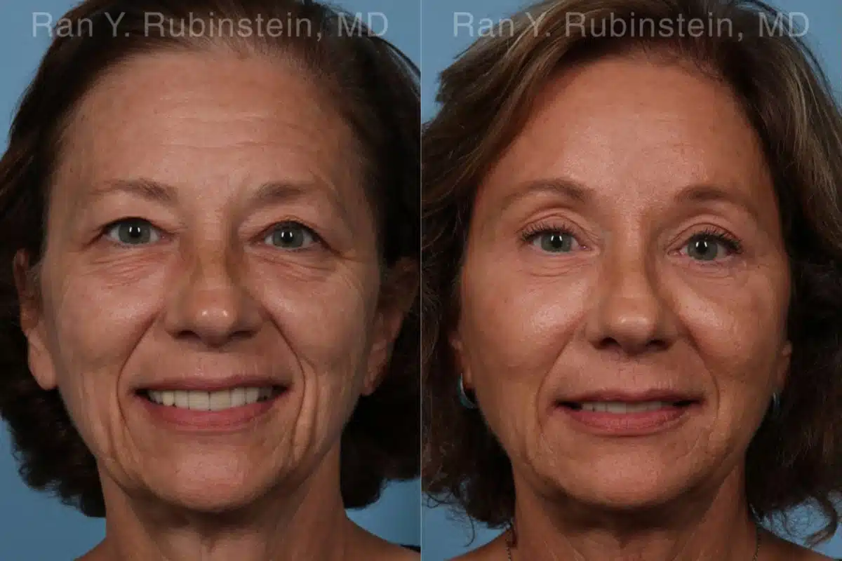 Brow Lift Before and After Photos in Newburgh, NY, Patient 19743