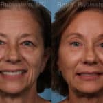 Brow Lift Before and After Photos in Newburgh, NY, Patient 19743