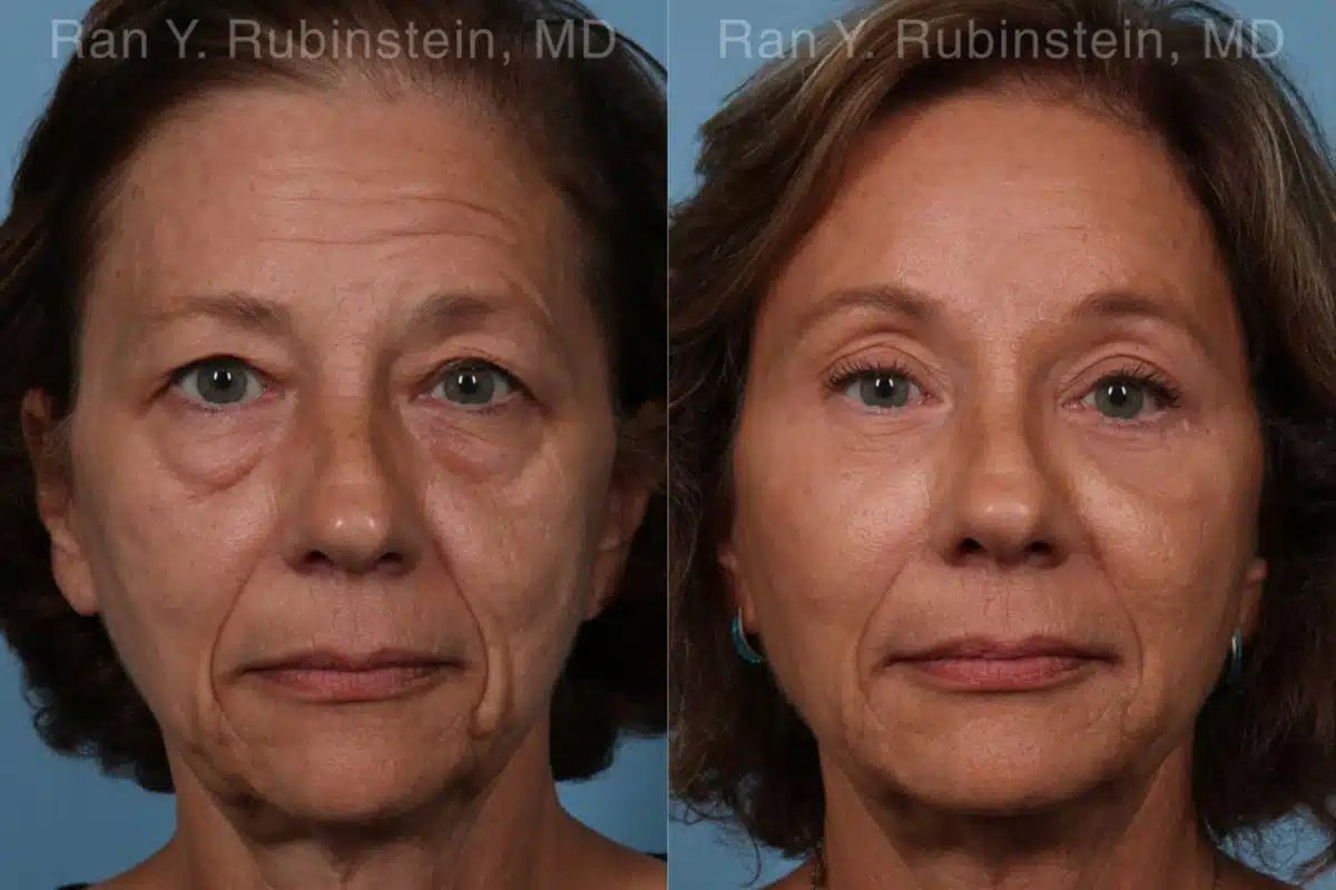 Brow Lift Before and After Photos in Newburgh, NY, Patient 19743