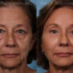 Brow Lift Before and After Photos in Newburgh, NY, Patient 19743