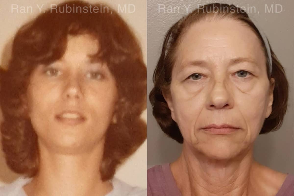 Brow Lift Before and After Photos in Newburgh, NY, Patient 19743