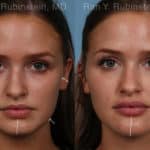 Chin Filler Before and After Photos in Newburgh, NY, Patient 19839