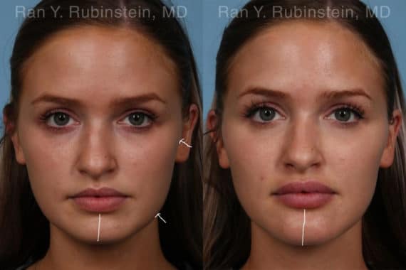 Chin Filler Before and After Photos in Newburgh, NY, Patient 19839