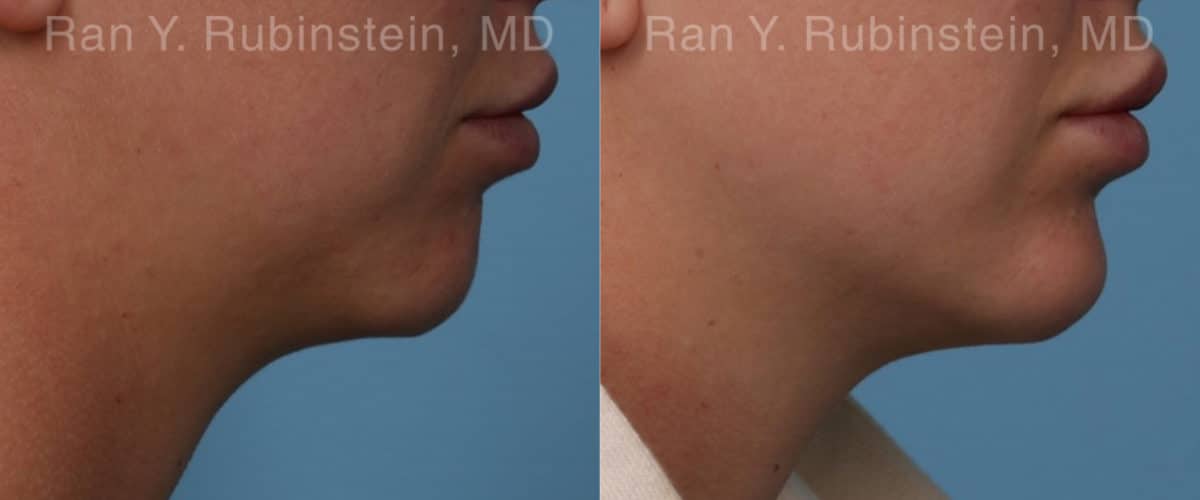 Chin Filler Before and After Photos in Newburgh, NY, Patient 19846