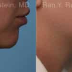 Chin Filler Before and After Photos in Newburgh, NY, Patient 19846