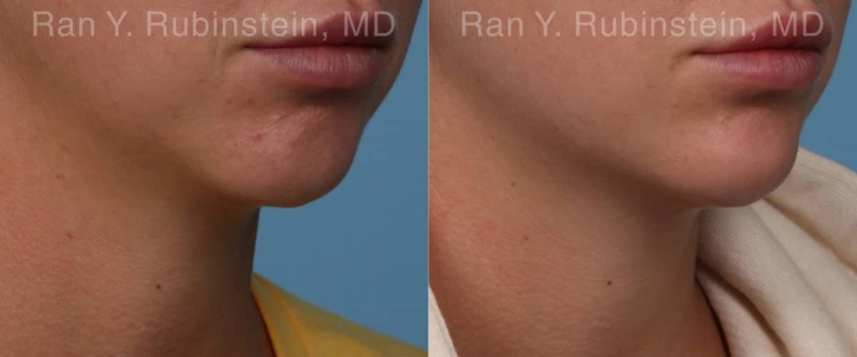 Chin Filler Before and After Photos in Newburgh, NY, Patient 19846