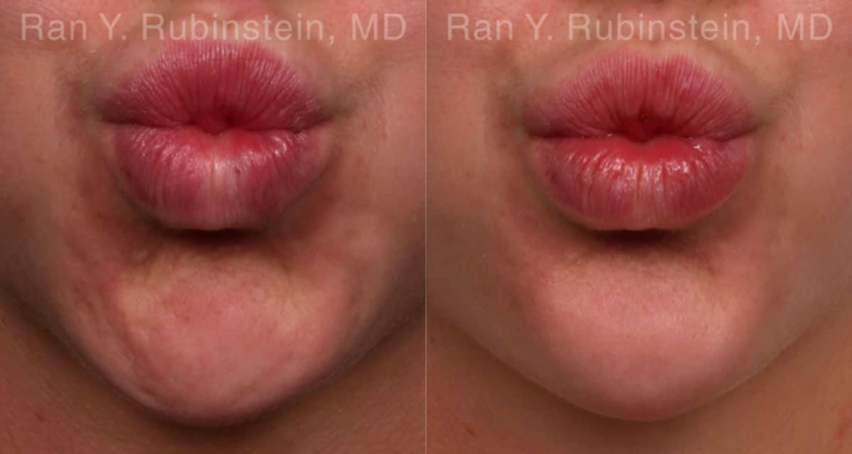 Botox Before and After Photos in Newburgh, NY, Patient 19853