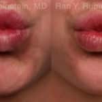 Botox Before and After Photos in Newburgh, NY, Patient 19853