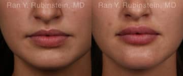 Lip Fillers Before and After Photos in Newburgh, NY, Patient 19857