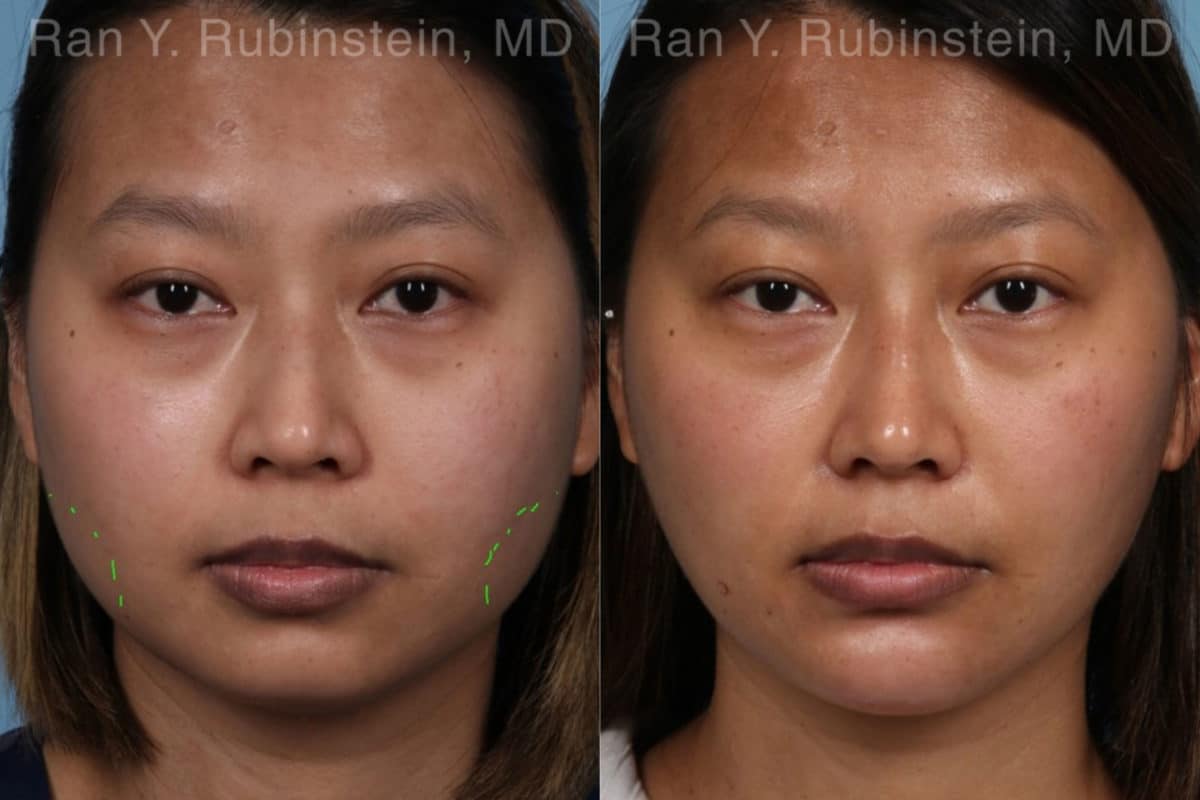 Botox Before and After Photos in Newburgh, NY, Patient 19957