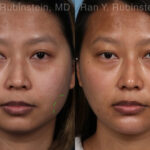 Botox Before and After Photos in Newburgh, NY, Patient 19957