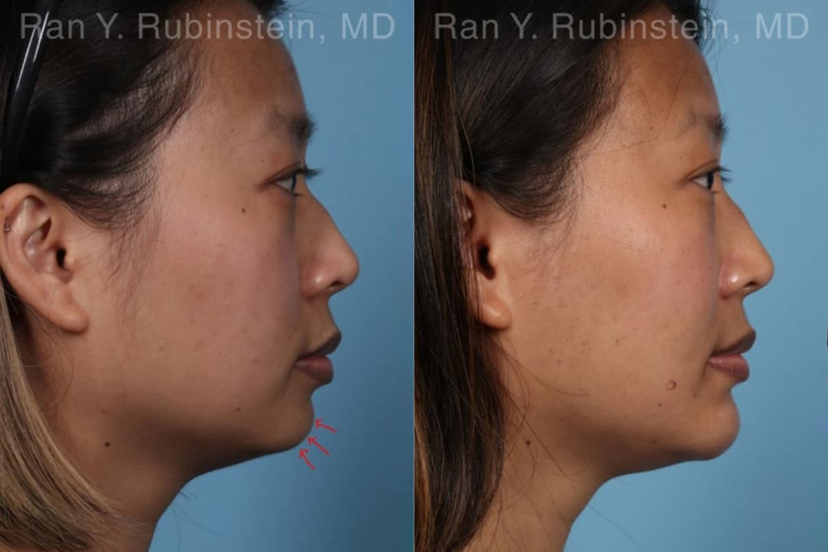 Chin Filler Before and After Photos in Newburgh, NY, Patient 19961