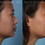 Chin Filler Before and After Photos in Newburgh, NY, Patient 19961