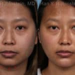 Chin Filler Before and After Photos in Newburgh, NY, Patient 19961