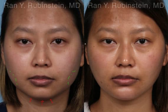 Chin Filler Before and After Photos in Newburgh, NY, Patient 19961