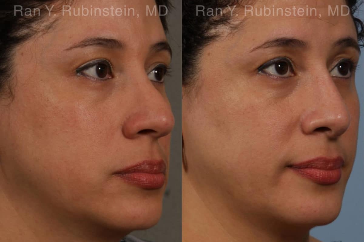 Revision Rhinoplasty Before and After Photos in Newburgh, NY, Patient 20011