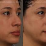 Revision Rhinoplasty Before and After Photos in Newburgh, NY, Patient 20011