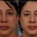 Revision Rhinoplasty Before and After Photos in Newburgh, NY, Patient 20011