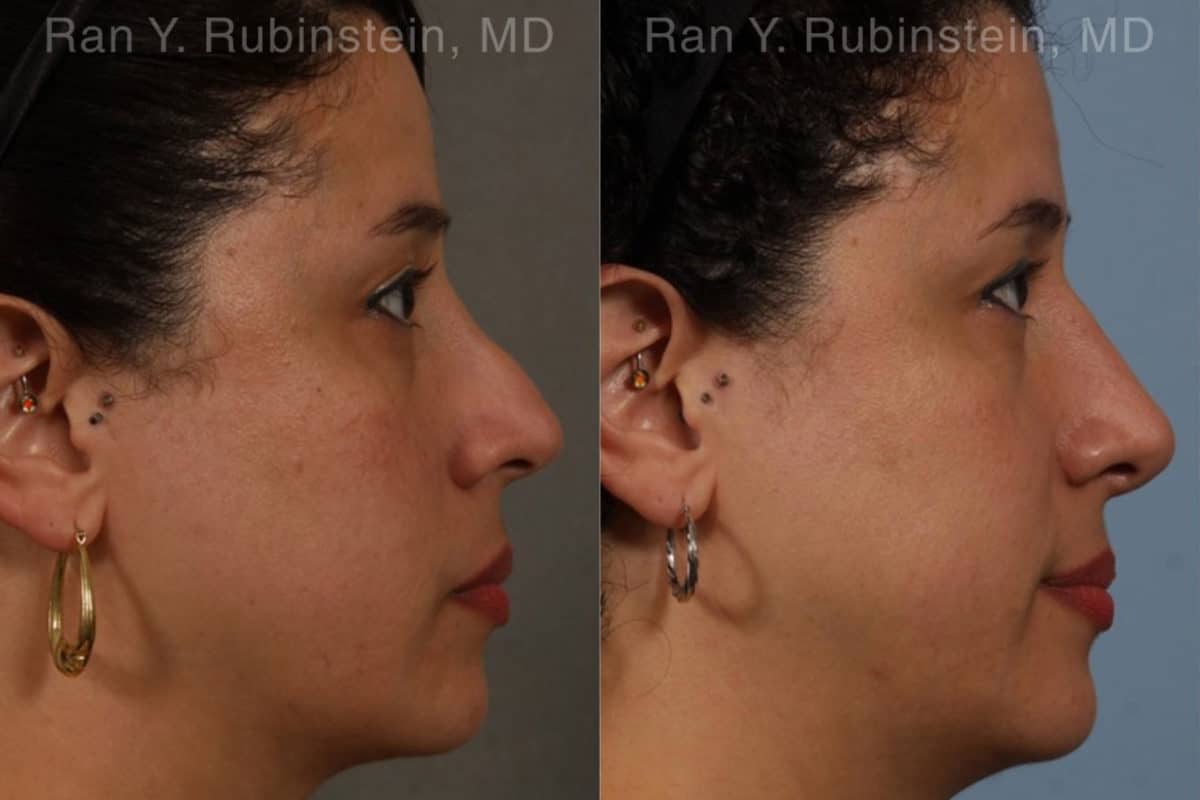 Revision Rhinoplasty Before and After Photos in Newburgh, NY, Patient 20011