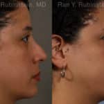 Revision Rhinoplasty Before and After Photos in Newburgh, NY, Patient 20011