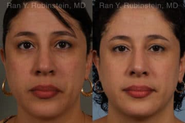 Revision Rhinoplasty Before and After Photos in Newburgh, NY, Patient 20011