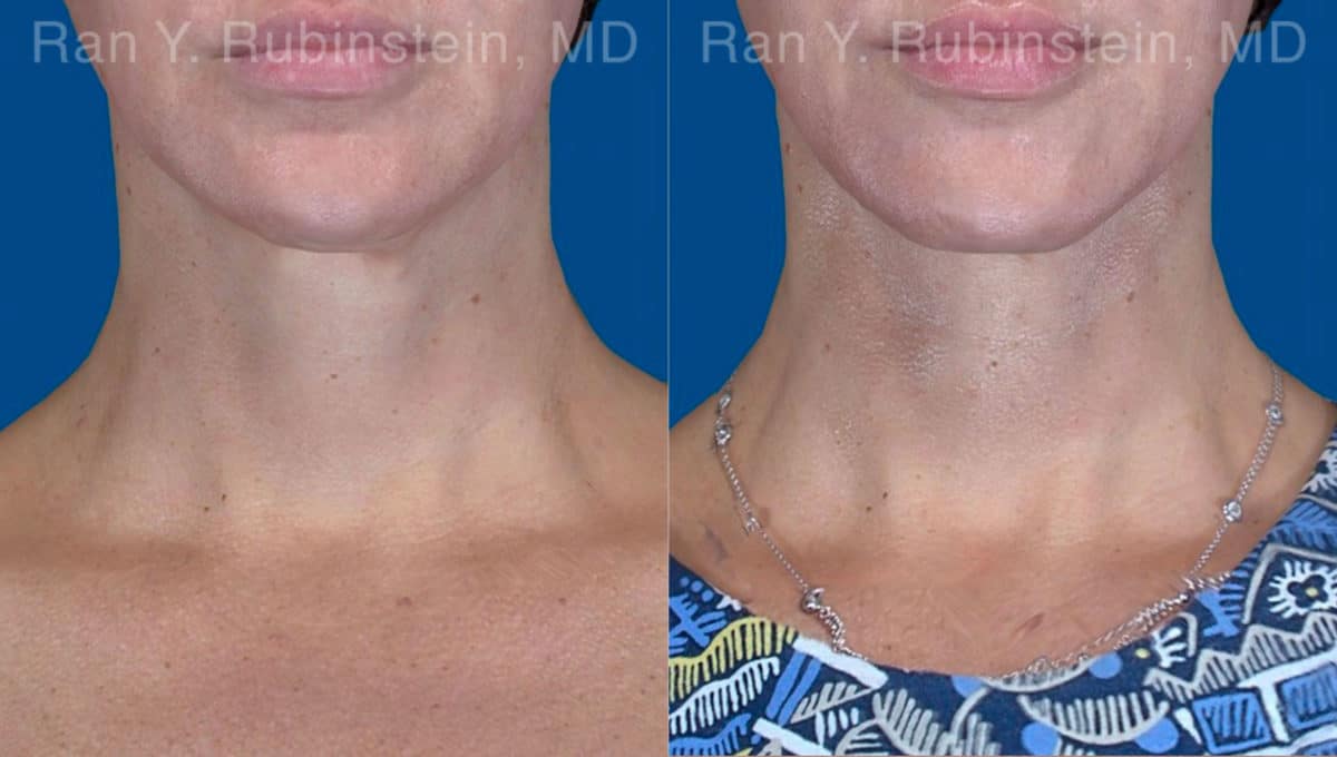 Face lift & Neck lift Before and After Photos in Newburgh, NY, Patient 20068