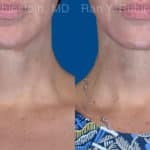 Face lift & Neck lift Before and After Photos in Newburgh, NY, Patient 20068