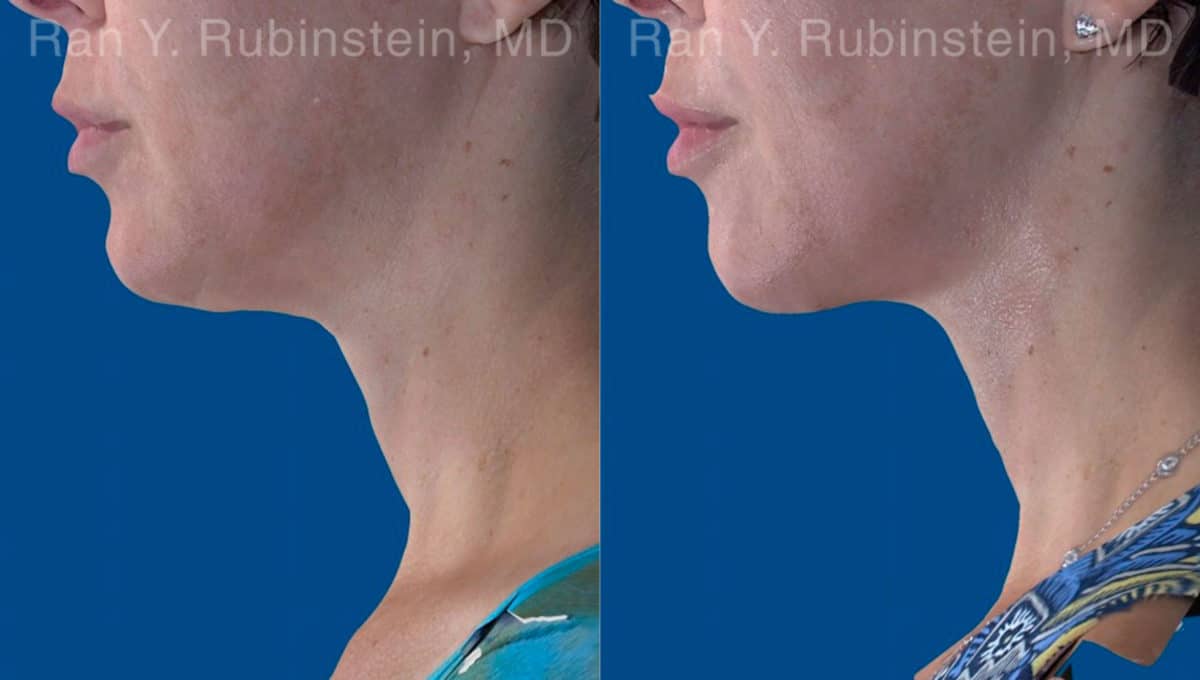 Face lift & Neck lift Before and After Photos in Newburgh, NY, Patient 20068