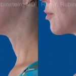 Face lift & Neck lift Before and After Photos in Newburgh, NY, Patient 20068