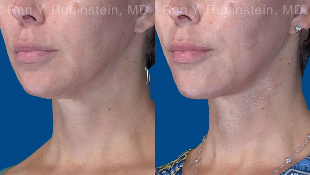 Face lift & Neck lift Before and After Photos in Newburgh, NY, Patient 20068